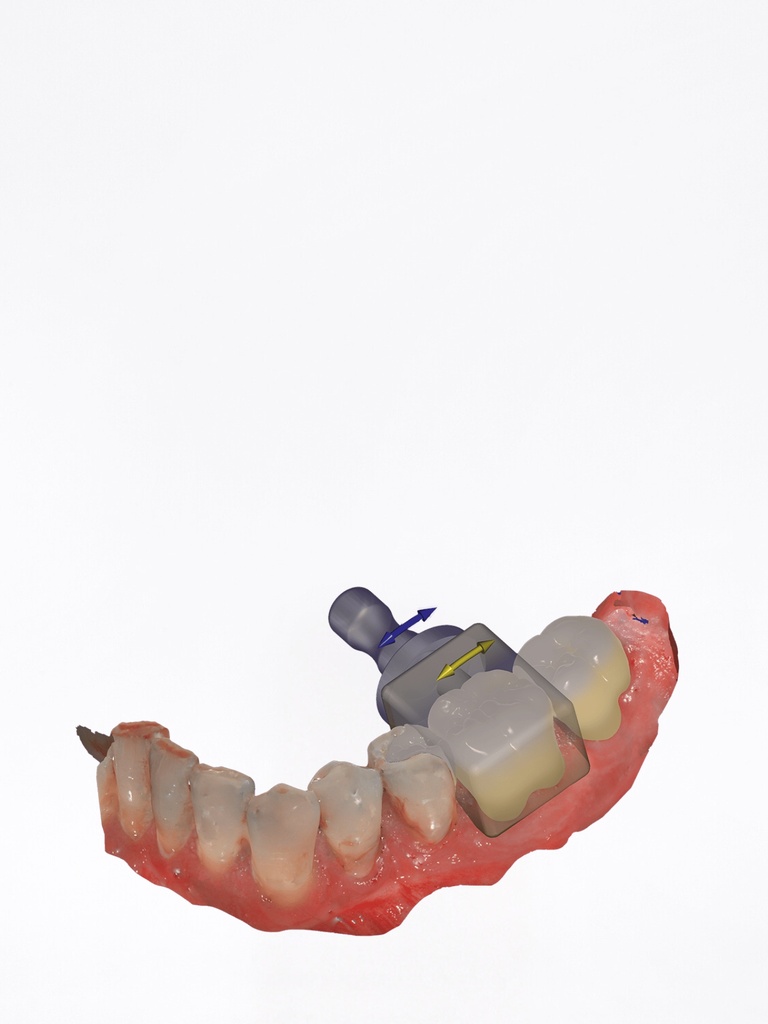 DentalCAD - Modulo In-CAD Nesting Flex